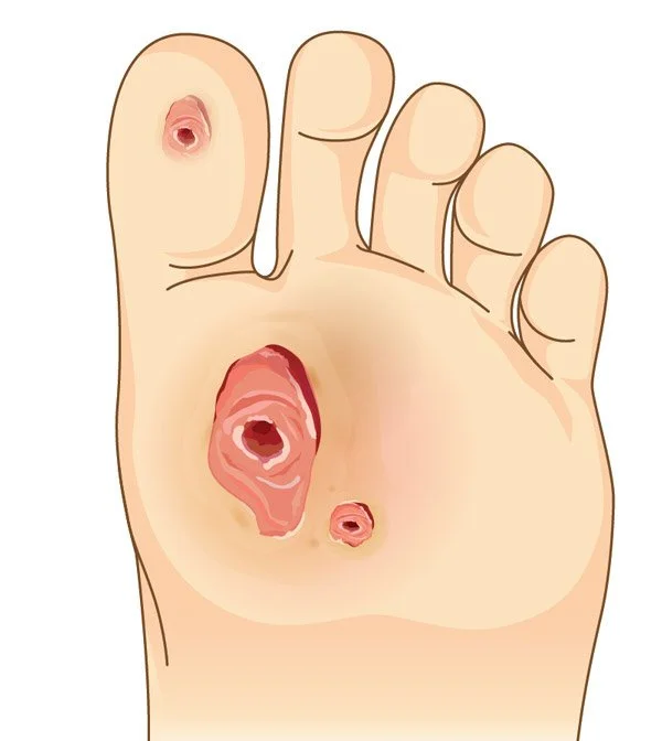 Illustration of plantar diabetic foot ulcers
